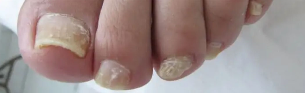 hongos en las uñas