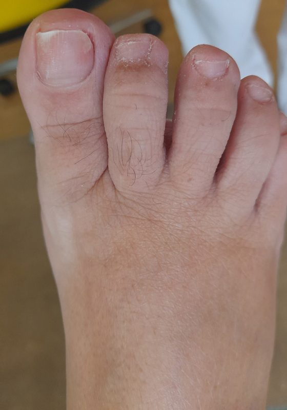 onicomicosis